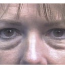Transconjunctival Blepharoplasty