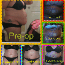 pre-op to 5 weeks post-op