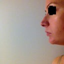Before - hump on nose, over projected