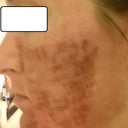 Day 4 Left (peeling)