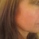 10 Days post-peel