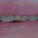 Before Pic.  This is my best "normal" smile - usually dig my snags into my bottom lip so they don't look so jagged.