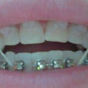 This is the 1st day of having braces.