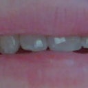 Before Pic.  Right side smile