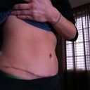 5 months PO  : (
