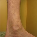 ankle after vein surgery, can still see incisions
