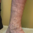 Varicose veins in ankle bone area before surgery