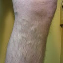Male varicose veins in knee before laser surgery