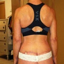 3.5 months post op.  No arm scars are visible from the front or back when standing like this.