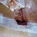 The beginning of the hematoma causing problems