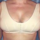 3 weeks post op and I don't have boob overflow.