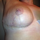 Incisions are looking awesome. I am so happy with how they look!
