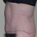 8 wk postop