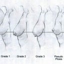 Nifty Ptosis chart.  Ptosis is when your nipple falls below the inframammary fold, and a surgical lift is the only way to get it back up there.  With all my other boob problems, I'm relieved that Ptosis isn't one of them.