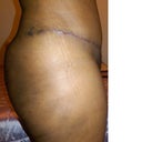 4 weeks post op