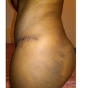 4 weeks post op