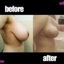 before and after (Sideview)