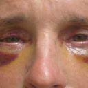 My eyes after surgery ~ you have to work with your lids and keep lubricant on them.