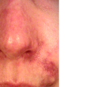 day 1: "bruising" and please note discolouration on the nose which happened within a few hours after procedure