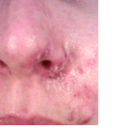 day 3: swelling, redness, pain and first sign of infection