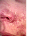 day 4: nose incredibly sore, spots plus sores are developing everywhere, infected area spreading rapidly