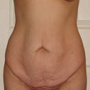 Front View Before Surgery