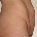 Side View Before Surgery