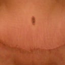 Front View After Surgery 4 Weeks healed