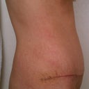 Side View After Surgery 4 Weeks healed