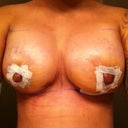 4 days post op 492cc lift on left breast
