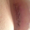 One of my incisions, 1wk post-op (tape still in place)