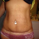 1 month post op. Still uneven swollen and no sign for flat stomach.