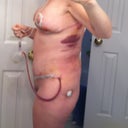 3 Days Post Op (2-11-12)