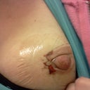 Frankenboob - post bobie biopsy pic. day 2.  5days till mommy makeover.