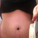 2-days post-op