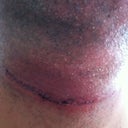 After Surgery (4 days later).  Right after drain tube removed.