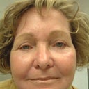 72 Year Old Woman Has Phenol Peel