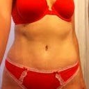 6 months Post OP feeling GREAT!