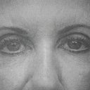 Eyes before fat graft, canthopexy and browlift-taken by a PS May 2012