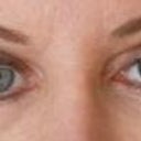 Eyes after surgery-approx 3 months post op