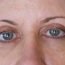 eyes almost 4 months post op.  Dont think they will improve much more according to 3 doctors I've seen already. This was taken April 213