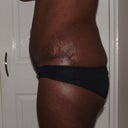 A side view, yep seroma still there