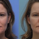 Front Before and After