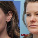 Left Side Before and After