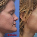 Profile Before and After