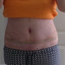 15 days post op