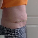 15 days post op