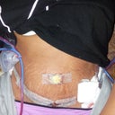 This was 1 Day Post Op.