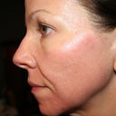 Day #5 left side - skin is more even color now, but hard to tell if it has smoothed the skin much.  I'm not sure when I should start noticing the scars smoothing  out more.