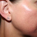 Day #5 Right side - again, hard to tell how much skin is smoothing but color is getting more even.